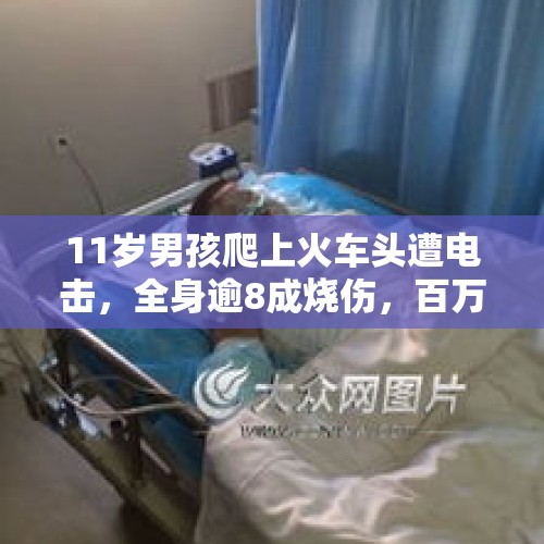 11岁男孩爬上火车头遭电击，全身逾8成烧伤，百万医疗费缺口难住家人 - 今日头条