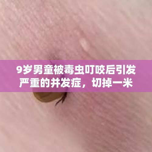 9岁男童被毒虫叮咬后引发严重的并发症，切掉一米肠管才保住命！ - 今日头条