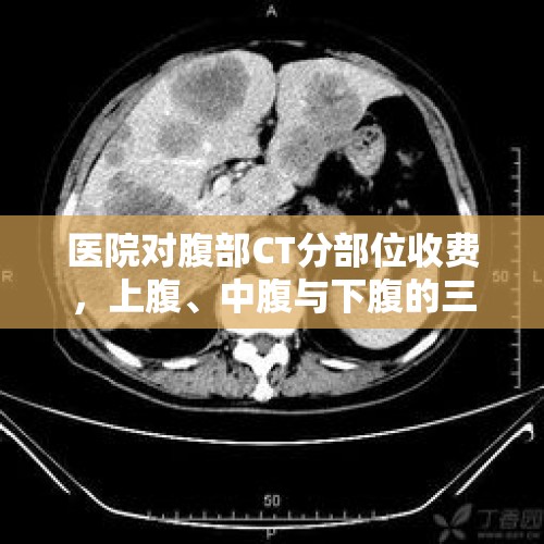 医院对腹部CT分部位收费，上腹、中腹与下腹的三次收费解析