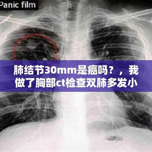 肺结节30mm是癌吗？，我做了胸部ct检查双肺多发小结节，请问会是癌症吗？