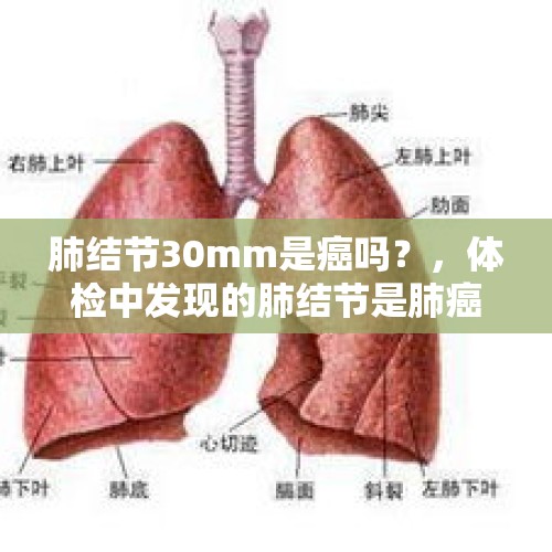 肺结节30mm是癌吗？，体检中发现的肺结节是肺癌吗？