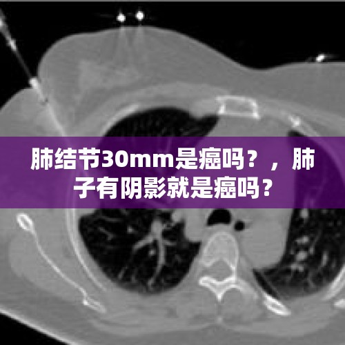 肺结节30mm是癌吗？，肺子有阴影就是癌吗？