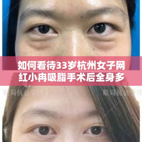 如何看待33岁杭州女子网红小冉吸脂手术后全身多器官衰竭，两个月后抢救无效死亡？医美存在哪些风险？，你吃过哪些没踩雷的网红美食？